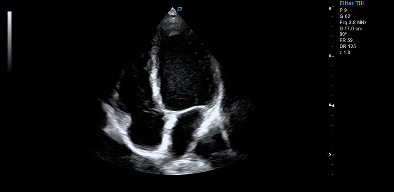 彩超機(jī)心臟檢測(cè)圖