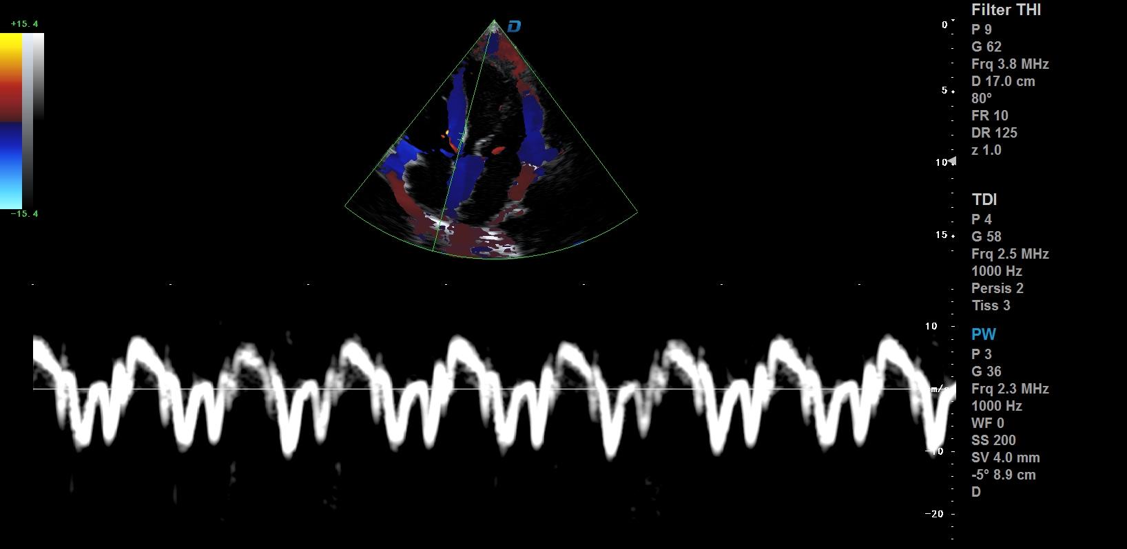 心臟彩超機(jī)和超聲心動圖的區(qū)別?