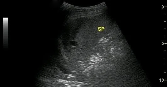 腹部超聲創傷性脾破裂的超聲診斷
